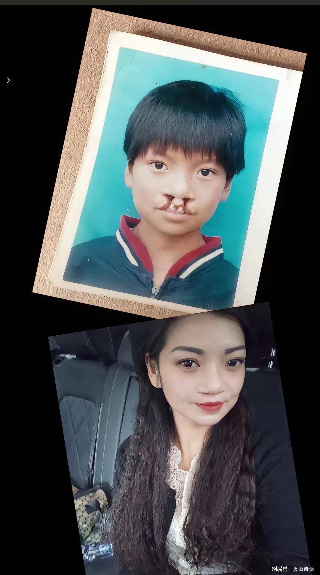 震惊！为声援李亚鹏，一漂亮女孩坦然展示自己唇腭裂手术前后照片